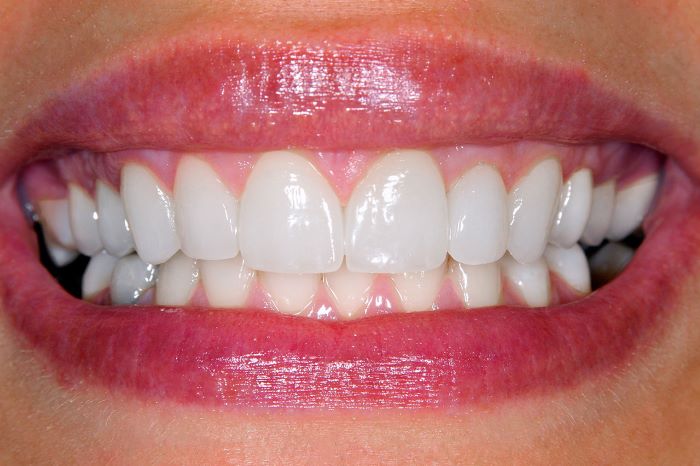 Advantages of Teeth Whitening