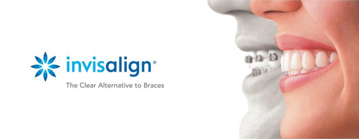 Invisalign Benefits