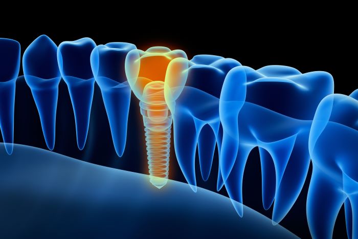 Dental Implants and Restorations
