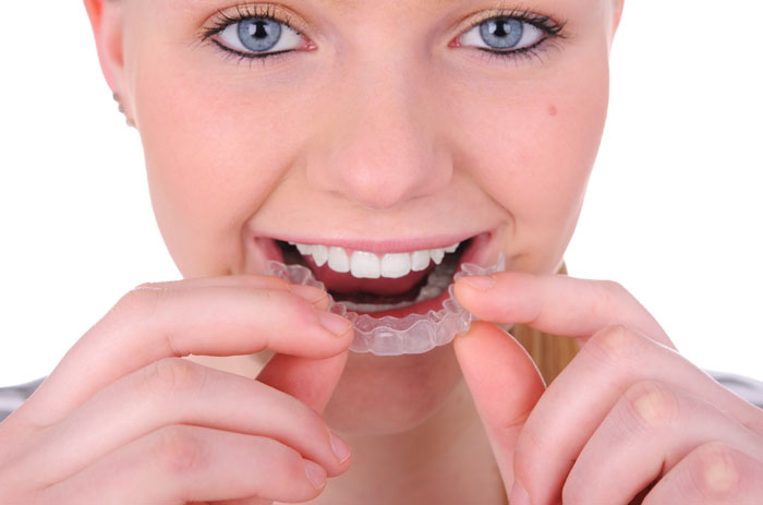 Invisalign Aligners