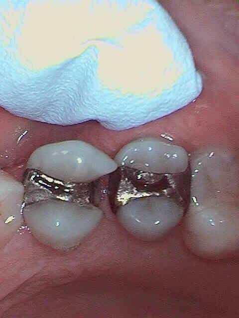 Dental Inlays and Onlays