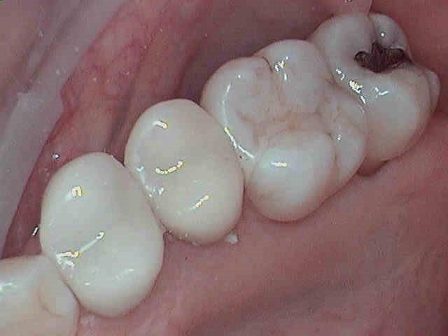 Tooth Colored Fillings