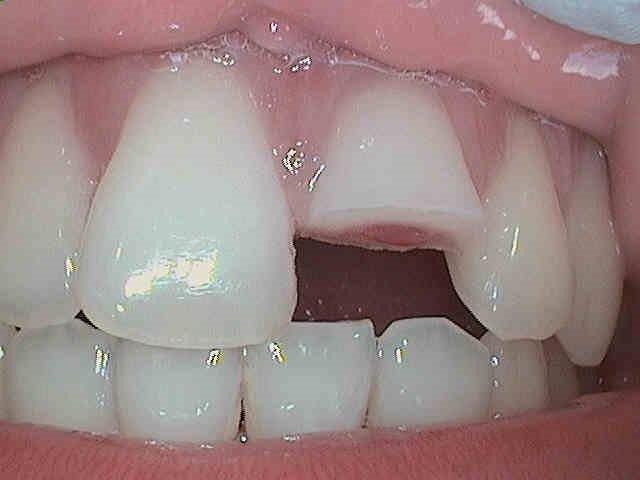 Dental Veneers