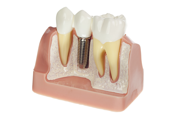 Dental Implants