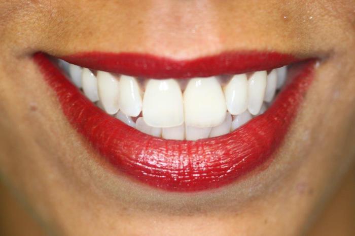 Teeth mold dental veneers - Front view Stock Photo