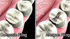 Dental Filling Materials