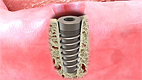 Implant for Dentures